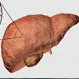 Fatty Liver