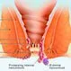 Picture of Hemorrhoid