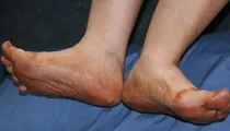 Diabetes Foot Problems Diabetes Foot Problems