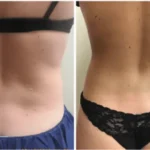 liposuction in Washington DC