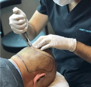  Hair Transplant in Turkey 